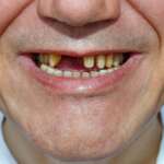 kako da vam ponovo izrastu zubi